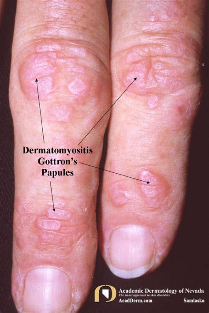 Dermatomyositis Flare Up Symptoms An identifying factor for