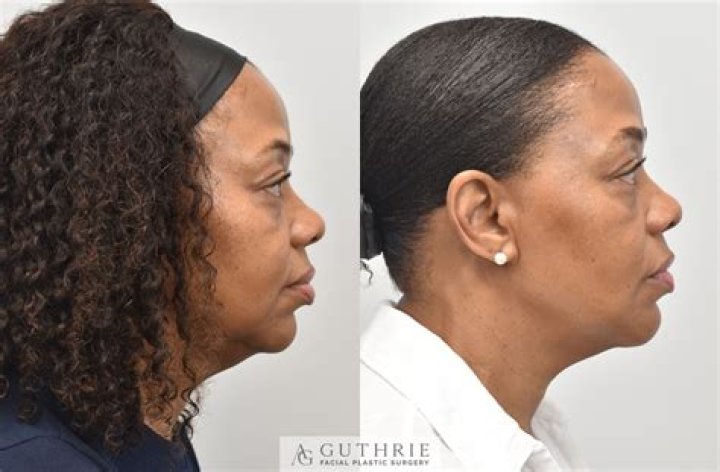 Facial Implants Guthrie Facial Plastic Surgery