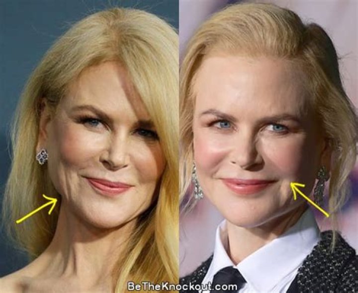Nicole Kidman Plastic Surgery Comparison Photos vrogue.co
