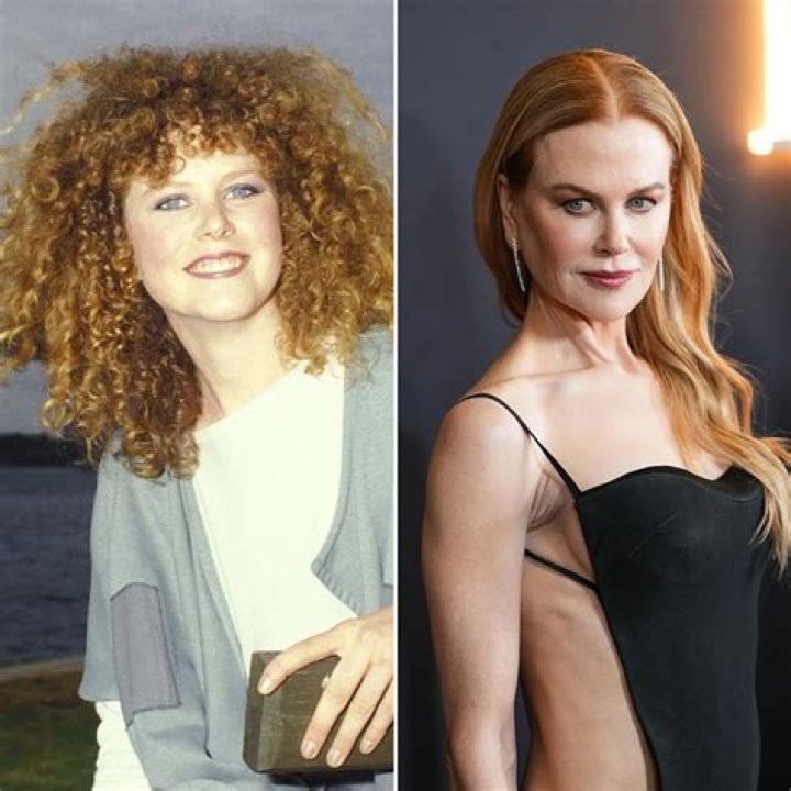 Nicole Kidman&rsquo;s NEW FACE Plastic Surgery Analysis Cambridge Breast