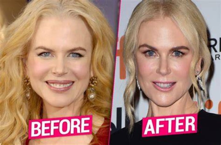 Nicole s nip tuck nightmare plastic surgeons blame facelift fillers