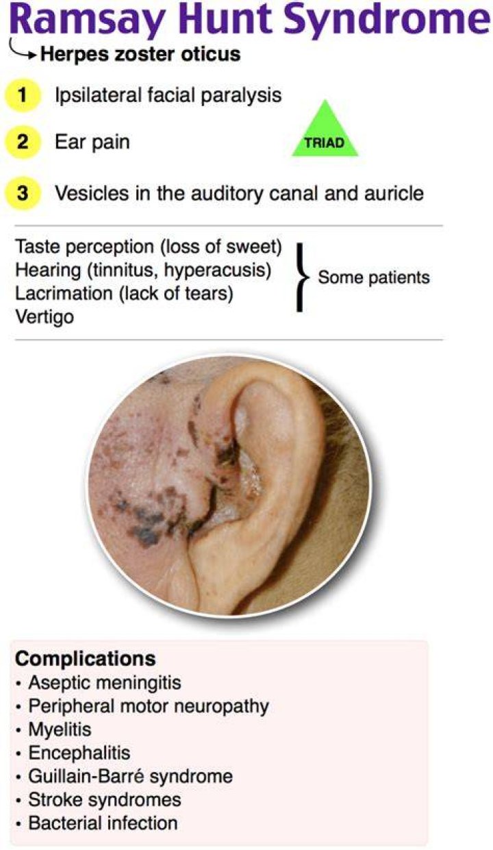 Ramsay Hunt Syndrome (Herpes Zoster Oticus) Causes & Treatment
