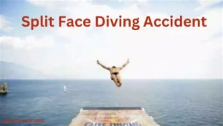 Shattered Dreams: The Impact Of A Face Splitting Diving Accident