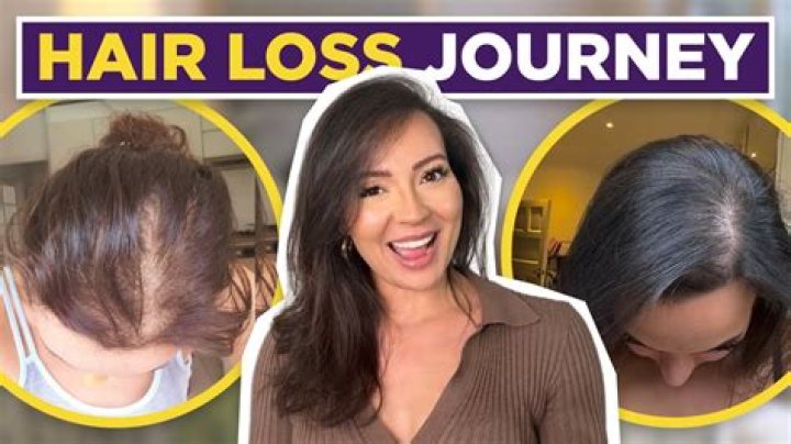 Understanding Barbara O'Neill's Hair Loss Journey