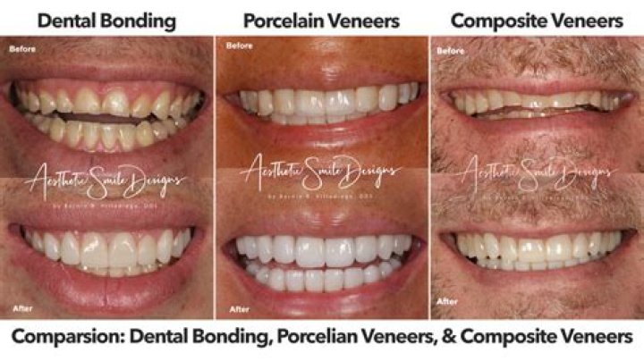 When Clip In Veneers Go Wrong: A Cautionary Tale
